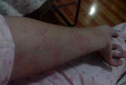 吃瓜过敏浑身红疙瘩,吃瓜引发的全身红疙瘩之谜
