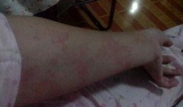 吃瓜过敏浑身红疙瘩,吃瓜引发的全身红疙瘩之谜