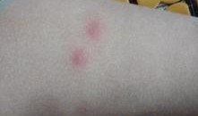 吃瓜过敏浑身红疙瘩,吃瓜引发的全身红疙瘩之谜